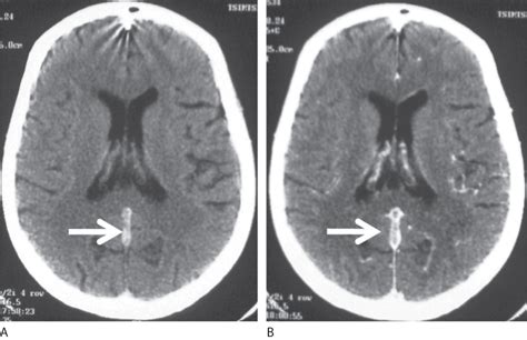 Chapter 14 Cerebral Venous Thrombosis Neupsy Key