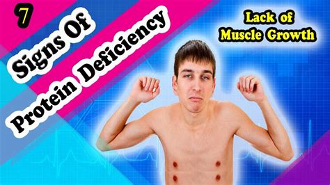 10 Signs And Symptoms Of Protein Deficiency Youtube