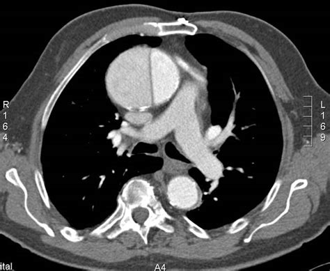 Aortic Dissection - Ain Health