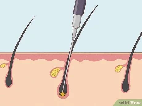 How To Stop Pubic Hair From Growing Permanently Store Aikicai Org