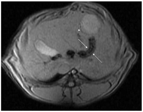 Axial T2 Weighted MR Image Of The Liver After Embolization With