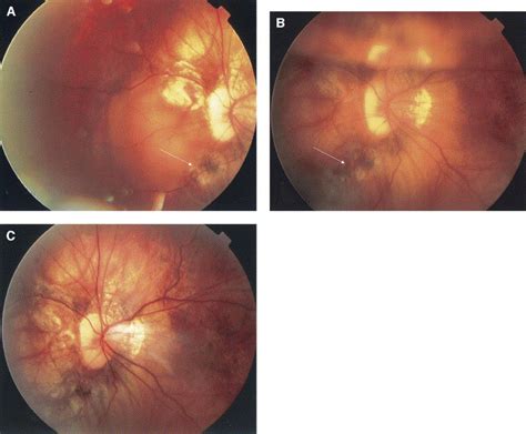 Rhegmatogenous Retinal Detachment In Phakic Eyes After Posterior