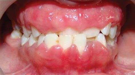 What Causes Swollen Gums? – Humber to Delacalle