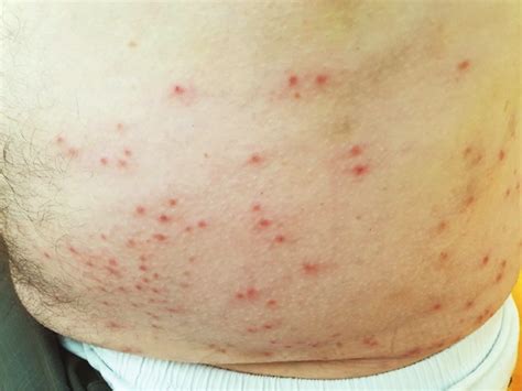 Symmetrical Purpleviolaceous Papules On The Gluteal Region Download