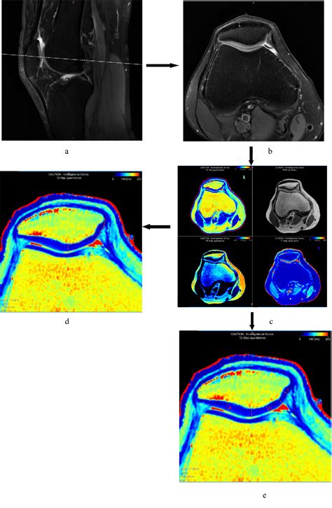 Difference In Quantitative Mri Measurements Of Cartilage Between Wiberg