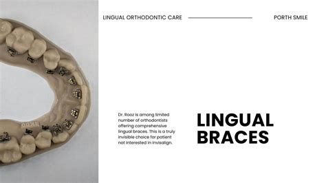 The Ultimate Guide To Lingual Braces Invisalign Vs Lingual Braces