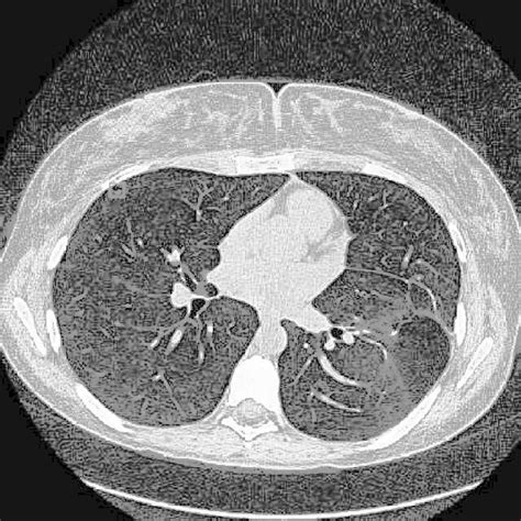 Lung Nodule Instance Instance Segmentation Dataset By Project