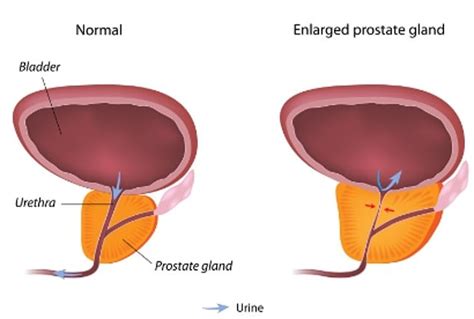 Searches For Enlarged Prostate Soar After King Charles Diagnosis