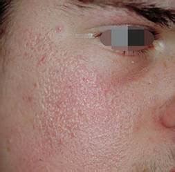 Erythromelanosis Follicularis Of The Face