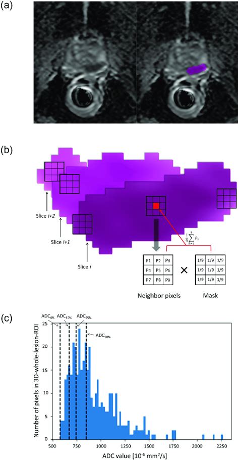 Computed Based Calculation For Adc Values Of Lesion A Prostate Download Scientific Diagram