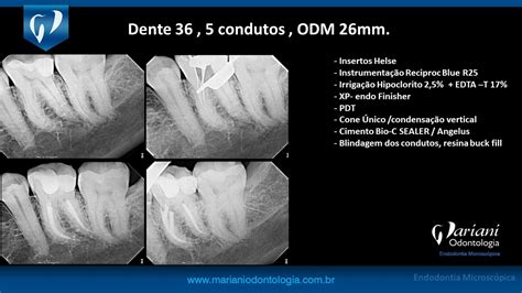 Casos clínicos endodontia Mariani Odontologia