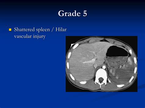 Ppt Jhsgr Management Of Blunt Splenic Injuries Powerpoint