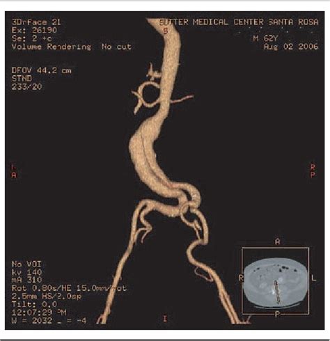 Figure From Endovascular Repair Of Abdominal Aortic Aneurysm With