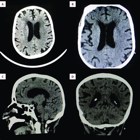 Multiple images of brain computed tomography scan (CT scan) without ...