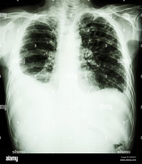 Película De Tuberculosis Pulmonar Radiografía De Tórax Derrame