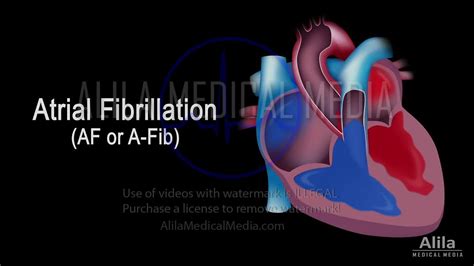 Alila Medical Media Atrial Fibrillation Narrated Animation Medical