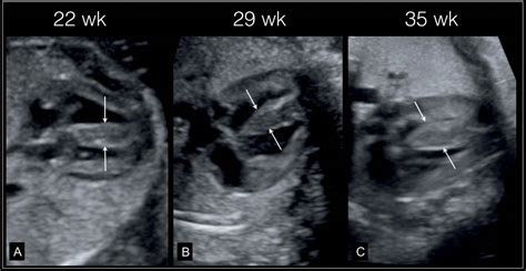 Fetal Cardiomyopathies And Fetal Heart Tumors Obgyn Key