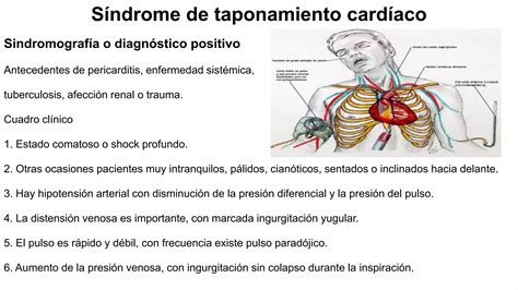 5 Síndrome de taponamiento cardíaco ppt