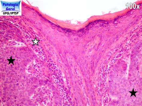 Carcinoma Basocelular Iptsp Patologia