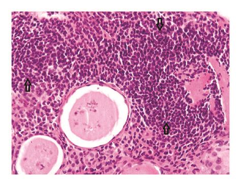 A Hematoxylin And Eosin Stain Show Typical Histopathological