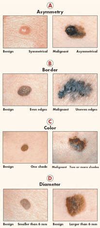 warning signs  skin cancer dca cancer