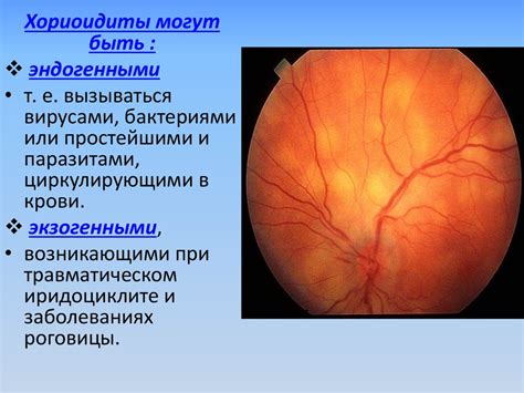 Сосудистая оболочка глаза - online presentation