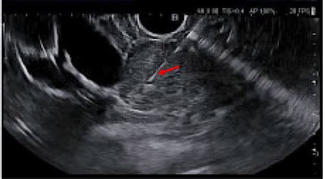 Endoscopic Ultrasound Eus Showing Fine Needle Biopsy Red Arrow Download Scientific Diagram