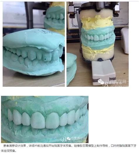 瓷睿刻贴面美学修复美学修复陕西嘉友科贸有限公司