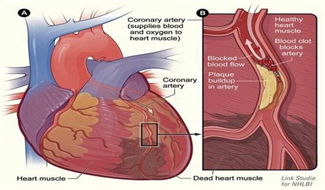 Kalp Krizi Nedir Belirtileri Nedenleri Ve Tedavisi Bilgigo