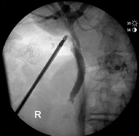 Cholangiogram Procedure