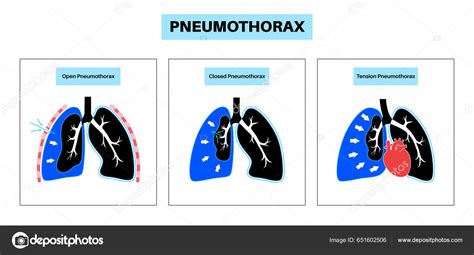 Enfermedad Del Neumot Rax Vector Plano Cartel M Dico Pulmonar Colapsado