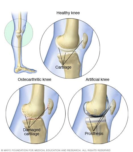 Osteoarthritis Diagnosis And Treatment Mayo Clinic