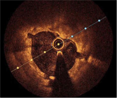 Frontiers Intravascular Imaging In Coronary Stent Restenosis