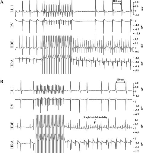 A Atrial Tachycardiafibrillation Atf Induced With Burst Pacing