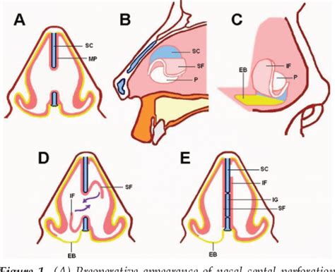 Figure From Repair Of Nasal Septal Perforation With Cross Stealing