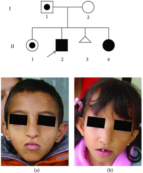 WolfHirschhorn Syndrome WikiProjectMed