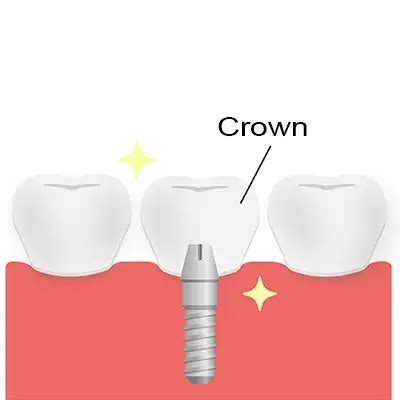 Dental Implants In Bundaberg East Side Dental