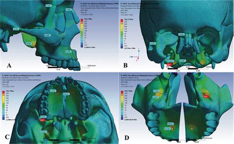 A And C Model I Unilateral Stress Distribution In The Craniofacial