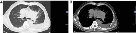 Figure 1 From A Rare Case Of Synchronous Multiple Primary Lung Cancer