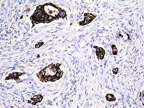 Metaplastic Carcinoma Of The Breast Bosnianpathology