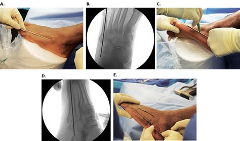 Intramedullary Screw Fixation Of Jones Fracture The Crucial Starting