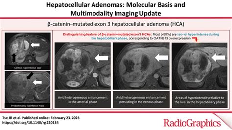 Hepatocellular Adenomas Molecular Basis And Multimodality Imaging