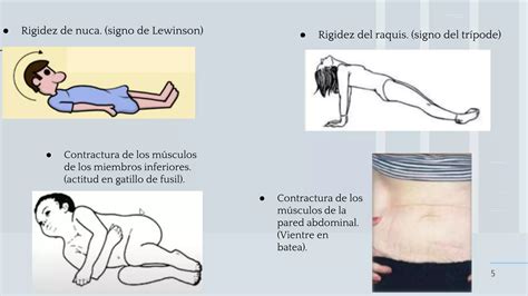 Signos Men Ngeos Semiolog A Medica Ppt