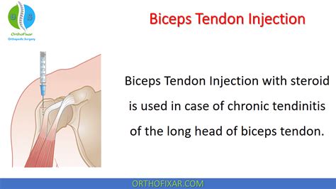 Biceps Tendon Injection Technique