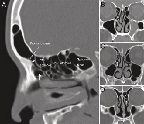 Table 1 from The association of frontal recess anatomy and mucosal ...