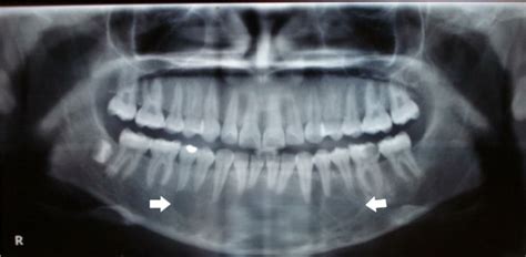 Panoramic Radiography Showing A Multilocular Radiolucent Area With Thin