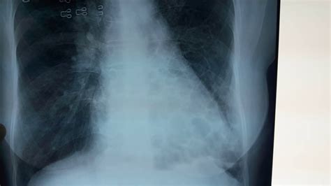 Bronchiectasis Chest X Ray What Is Bronchiectasis Youtube