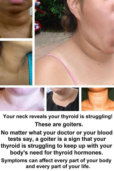 Thyroid Nodule On Tumblr