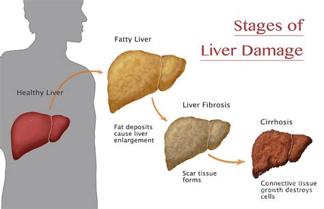 Liver Disease Stages