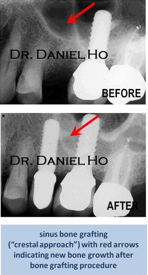 Maxillary Sinus Bone Grafting Spring Periodontics